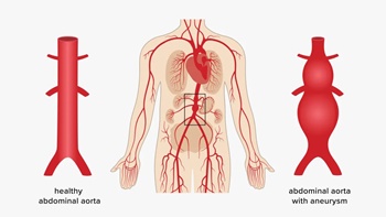 Anevrizma Nedir? Anevrizma Cerrahisi sonrası Fizik Tedavi