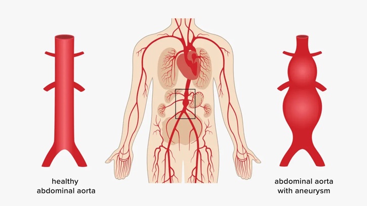 Anevrizma Nedir? Anevrizma Cerrahisi sonrası Fizik Tedavi