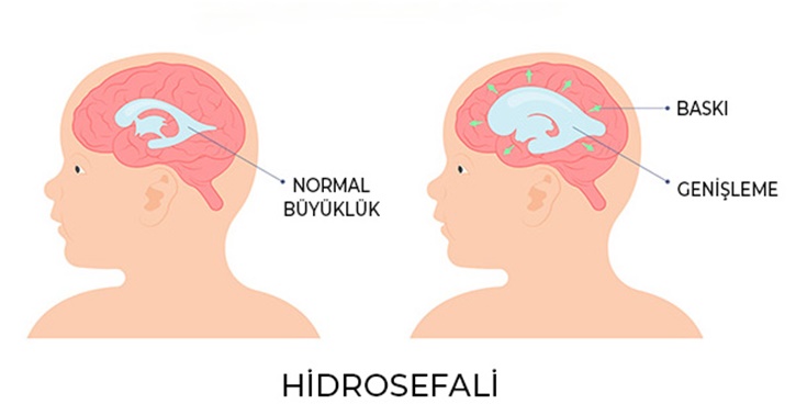 Hidrosefali Nedir? Hidrosefali'de Fizik Tedavi