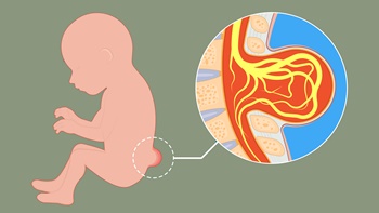 Spina Bifida Nedir? Sipina Bifida'da Fizik Tedavi